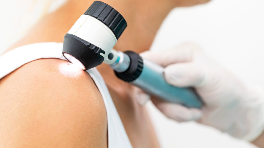 The ABCDE of skin cancer