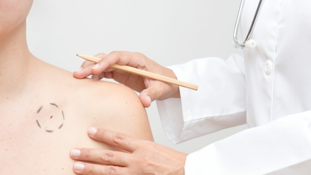 The ABCDE of Skin Cancer